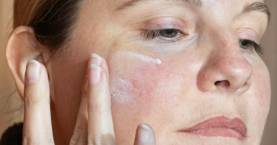 Environmental and emotional factors, including stress, heat and spicy foods, can be major triggers for rosacea flare-ups.