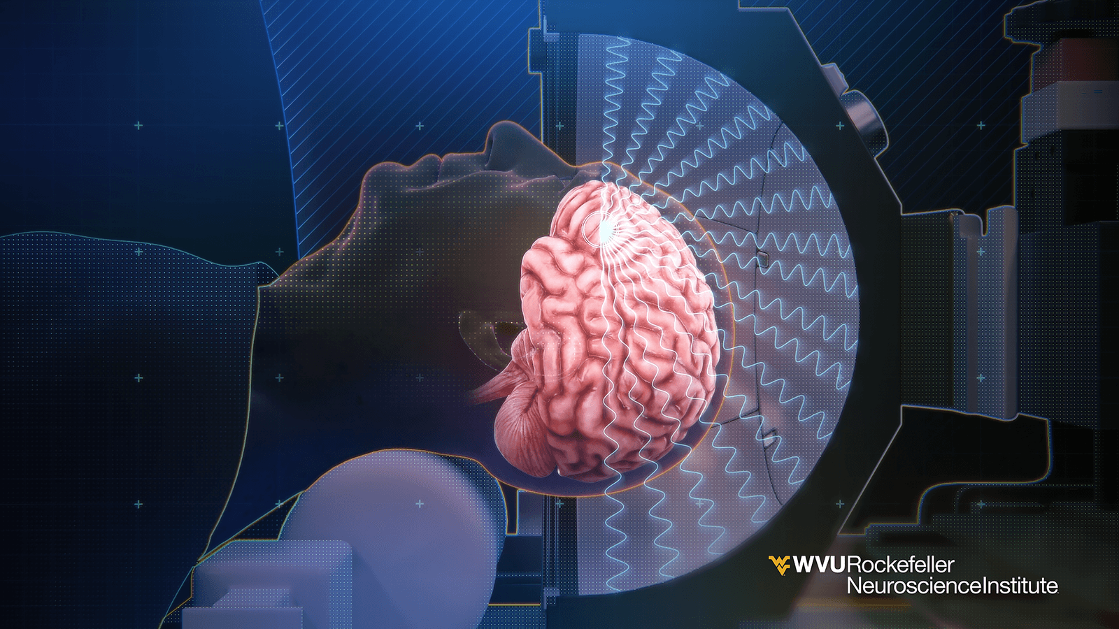 Lowintensity focused ultrasound can be used to noninvasively modulate targeted regions of the brains reward circuitry.